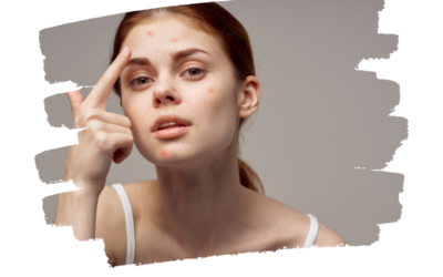 Extraire ou ne pas Extraire ? Peser les Avantages et les Risques pour la Peau